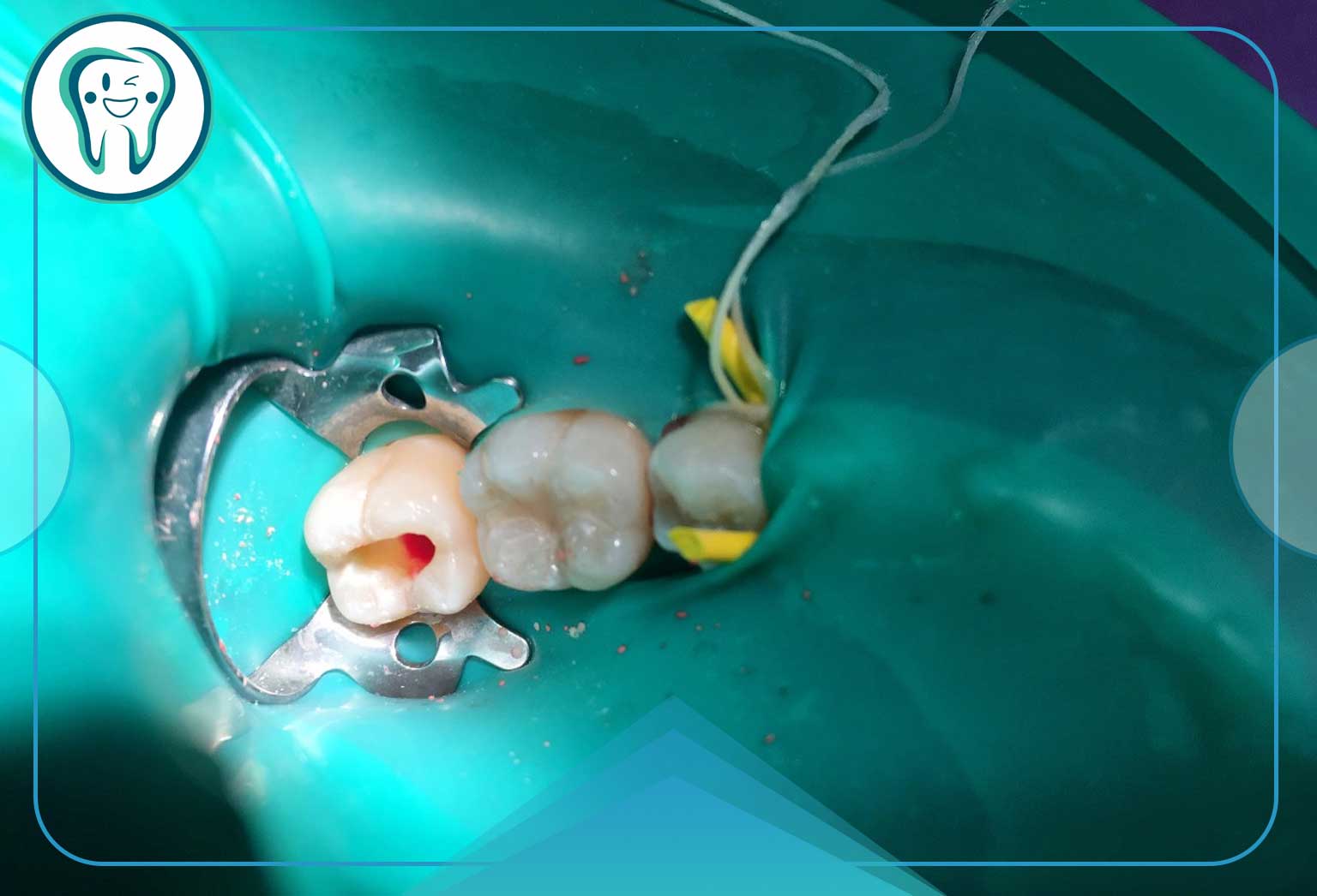 عصب کشی دندان شیری: آیا دندان شیری عصب کشی میشود؟ 1 پالپوتومی