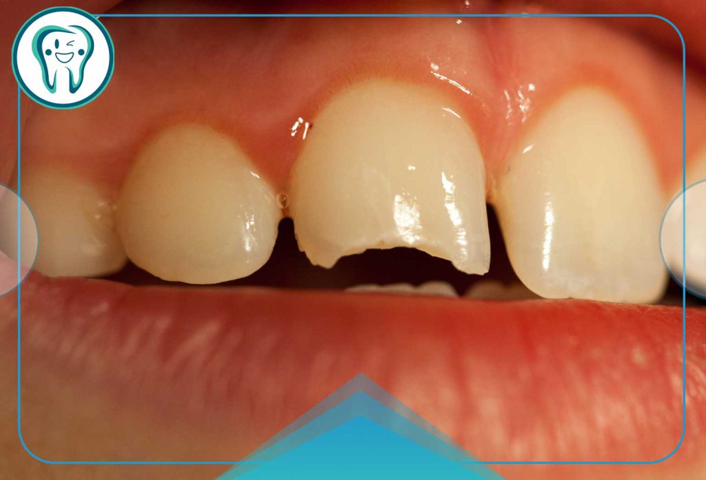Tooth enamel fracture