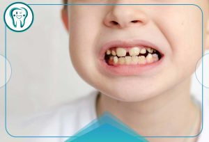 کلینیک دندانپزشکی قدس 26 هیپوپلازی دندان