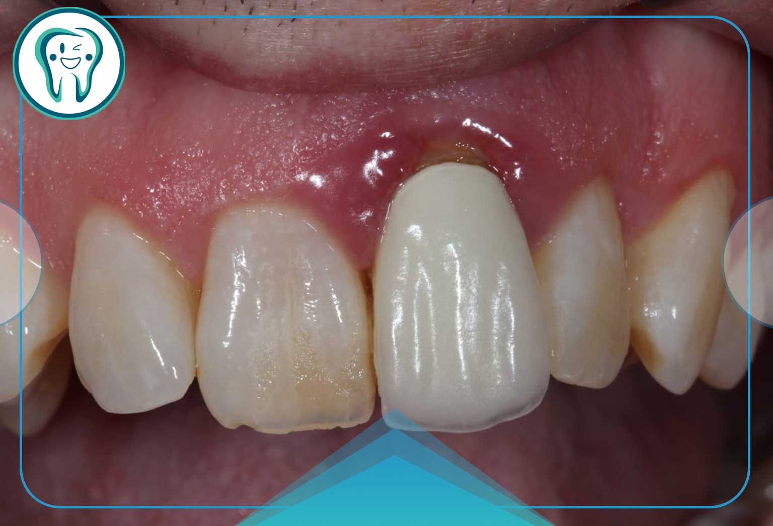 دلایل عفونت ایمپلنت دندان و نحوهی درمان آن 2 نشانههای هشدار دهنده عفونت ایمپلنت دندان