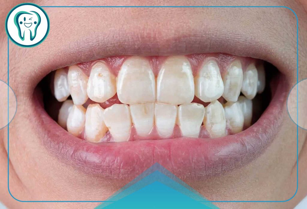 White or yellow spots on teeth