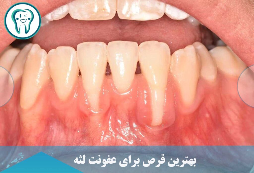 قرص برای عفونت لثه