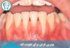 قرص برای عفونت لثه