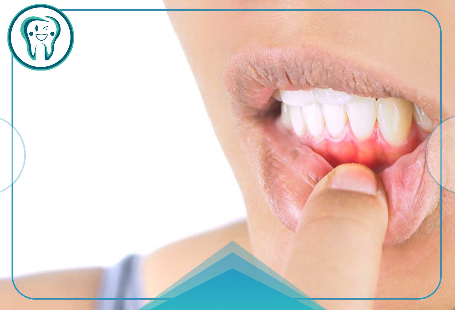 چرا خوردن قرص برای عفونت لثه به تنهایی لثه را درمان نمی‌کند؟ (یک حقیقت تلخ اما مهم)