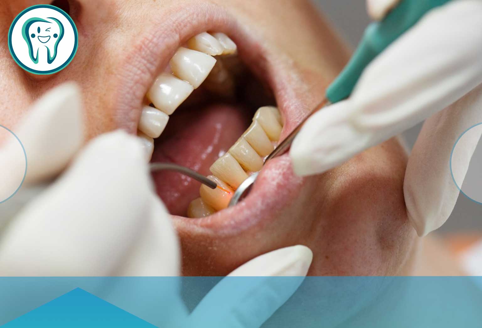 عفونت لثه چیست و چرا ایجاد می‌شود؟ (شناخت دشمن خاموش دهان)