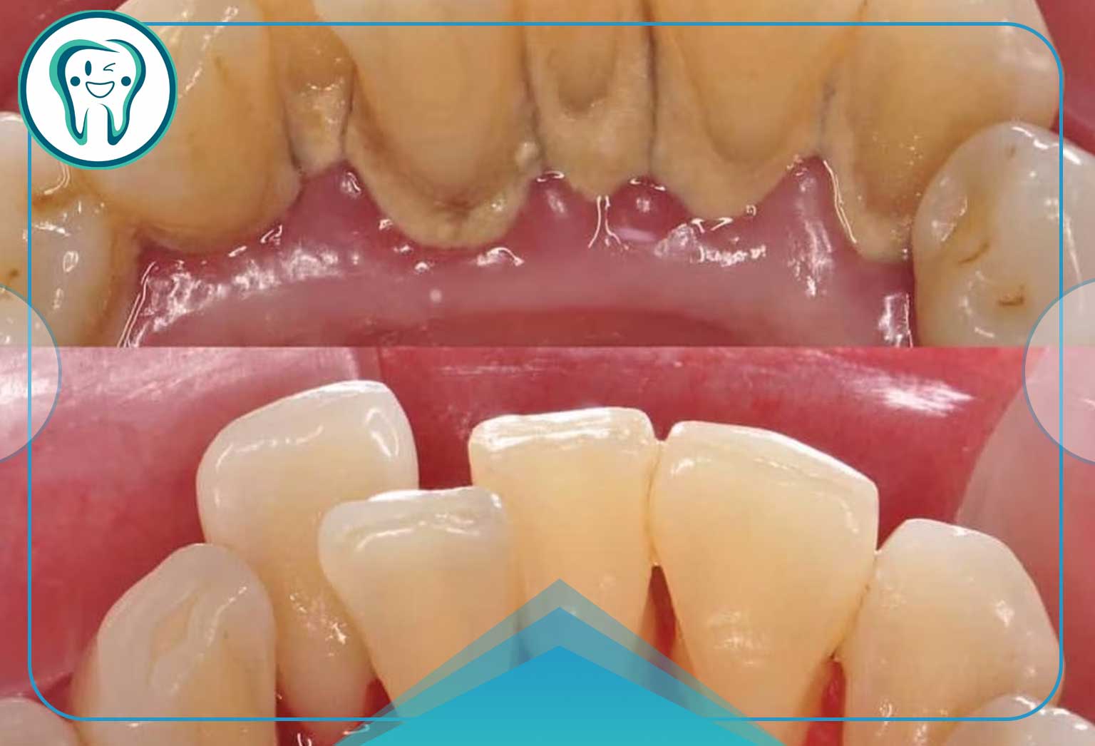 مراحل یک جرم گیری و بروساژ حرفه‌ای در کلینیک: تجربه‌ای فراتر از یک مسواک زدن ساده