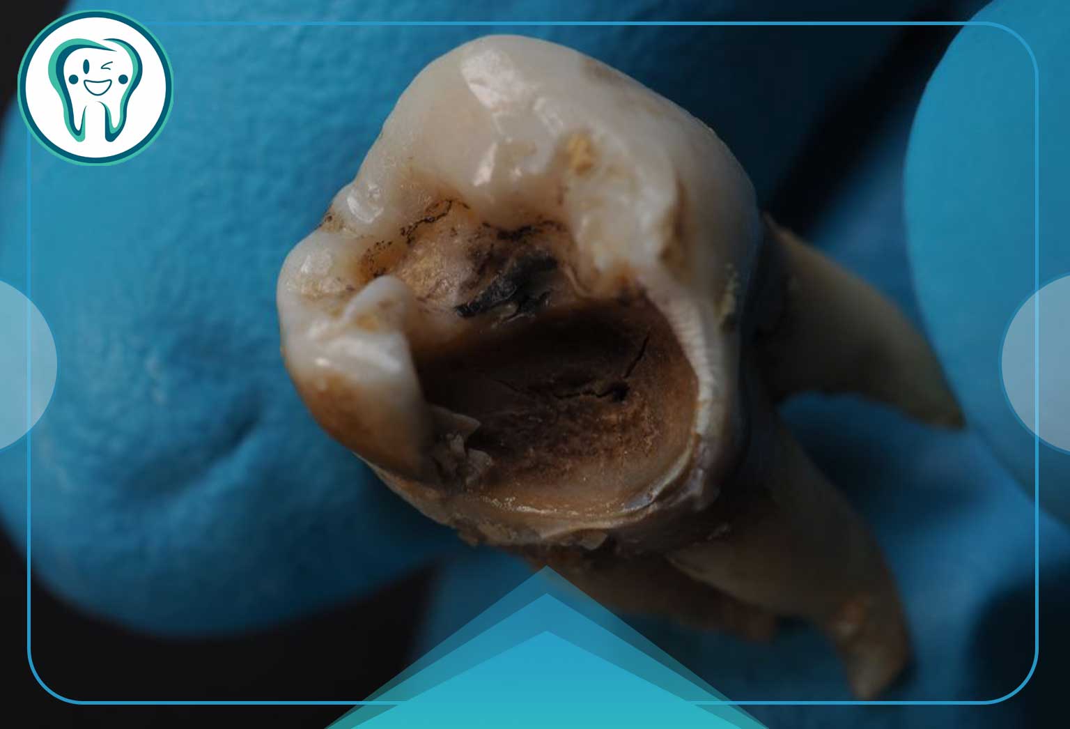 ریاضیات دندانپزشکی: چرا به تعویق انداختن درمان به ضرر جیب شماست؟