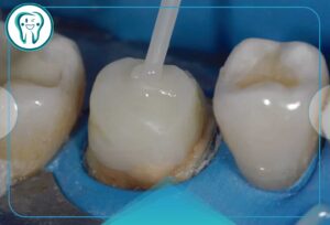 کلینیک دندانپزشکی قدس 23 کف بندی دندان