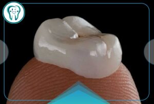 Dental crown after root canal treatment