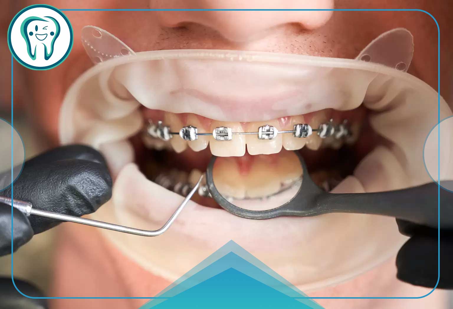 ایمپلنت و ارتودنسی همزمان؛ راهنمای کامل برنامهریزی درمان 1 درمان ایمپلنت و ارتودنسی