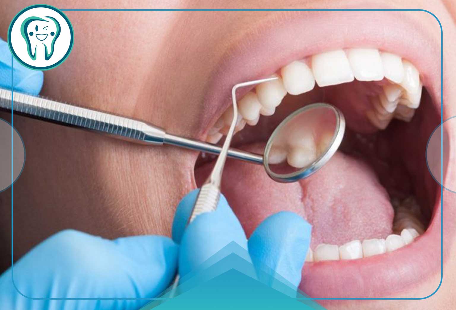Periodontal Scaling Root Planing 825x510 1