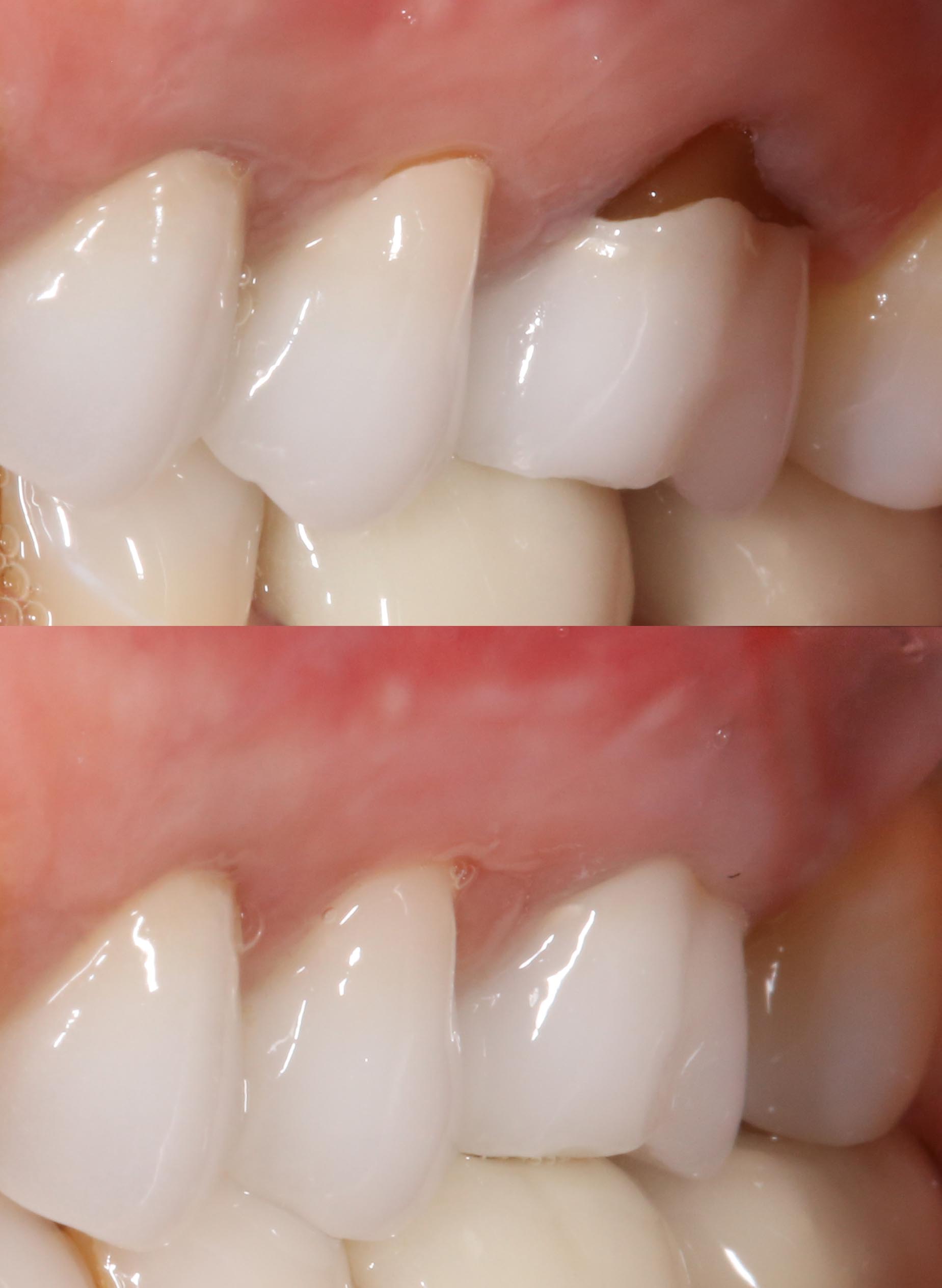 gum graft before and after