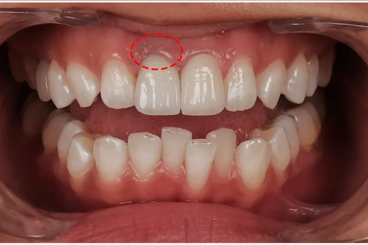 نصب نامناسب روکش دندان